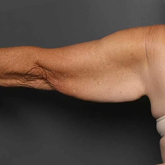 Arm Lift before photo