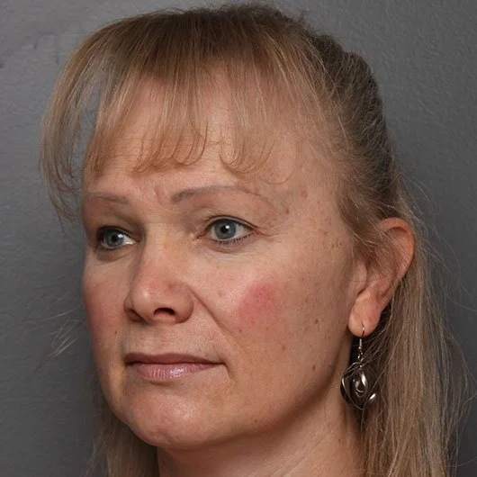 Lip Lift before photo