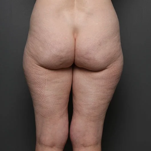 Liposuction before photo