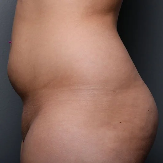 Liposuction before photo