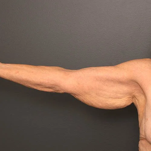 Liposuction before photo