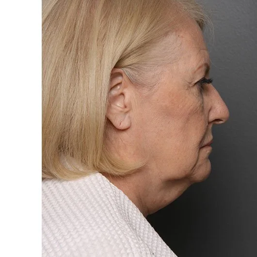 Neck Lift before photo