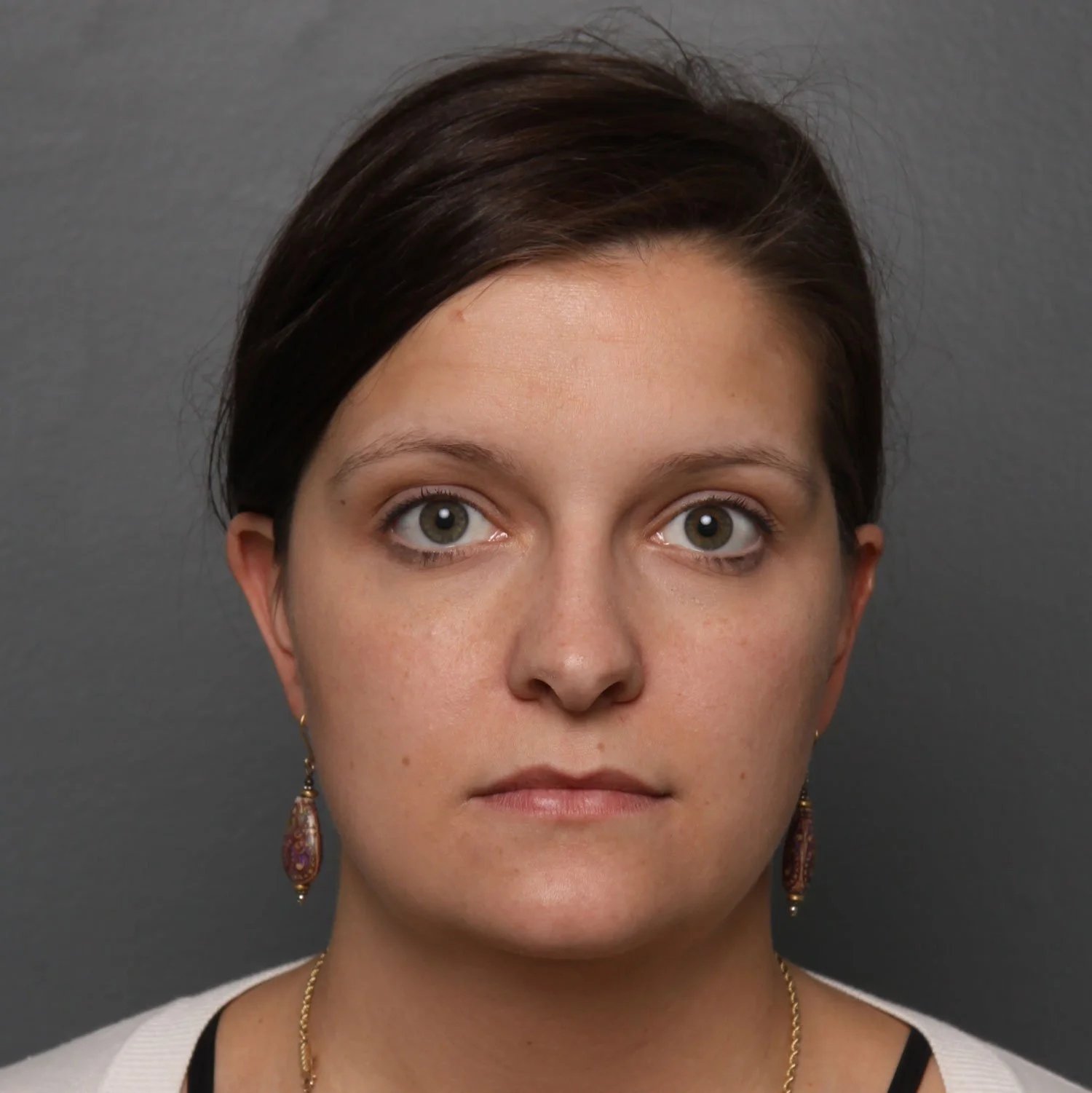 Neck Lift before photo