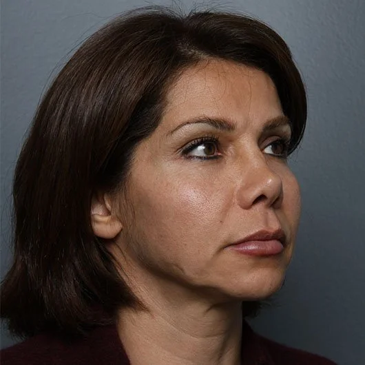 Lip Lift before photo