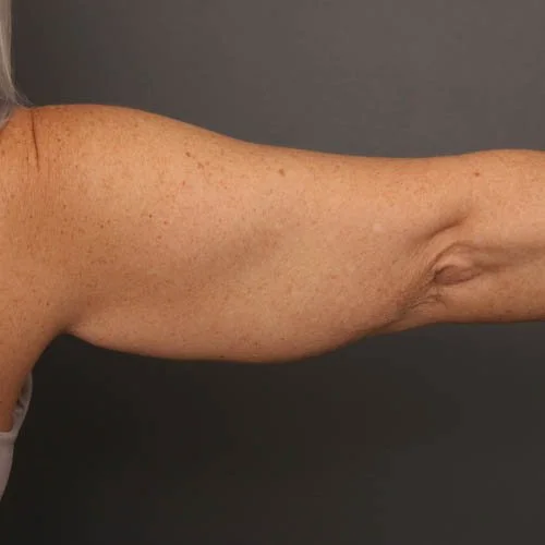Arm Lift before photo