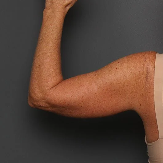 Arm Lift before photo