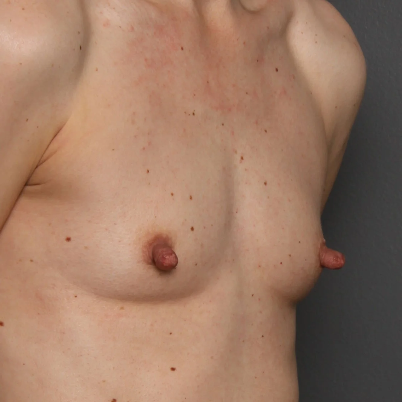 Breast Lift before photo