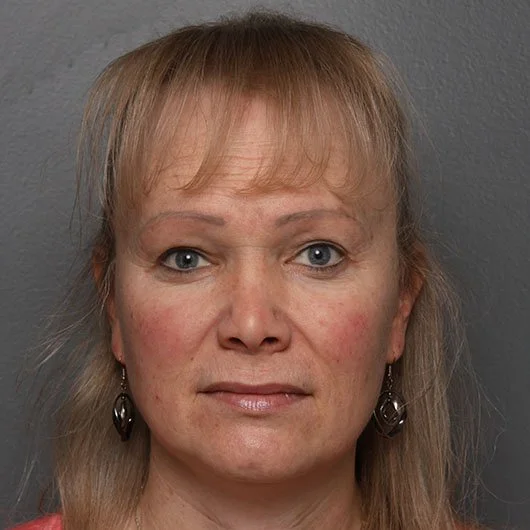 Lip Lift before photo