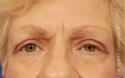 A result from Millard Plastic Surgery