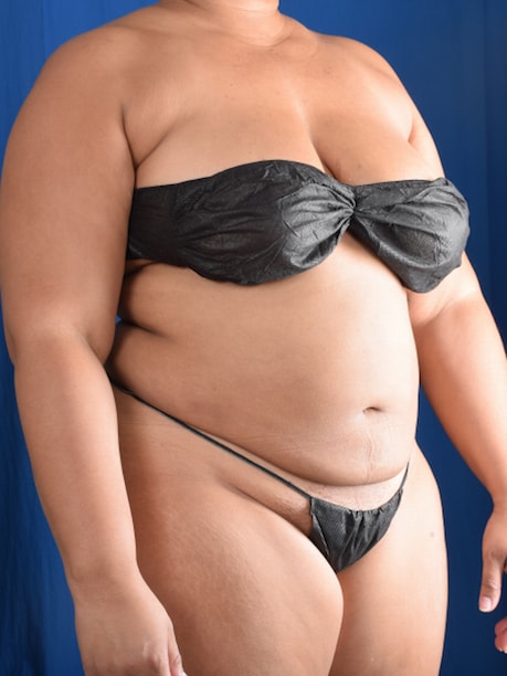 A result from Millard Plastic Surgery
