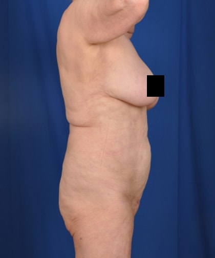 A result from Millard Plastic Surgery