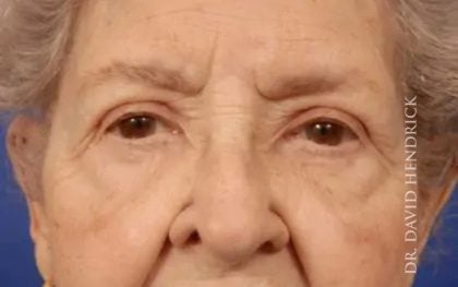 A result from Millard Plastic Surgery