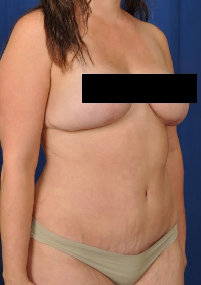 A result from Millard Plastic Surgery