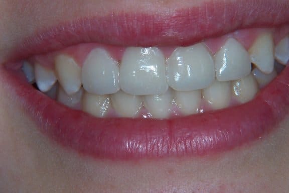 A result from Newport Beach Dental Solutions
