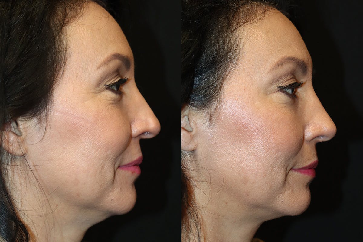 Rhinoplasty result at Stile Aesthetics