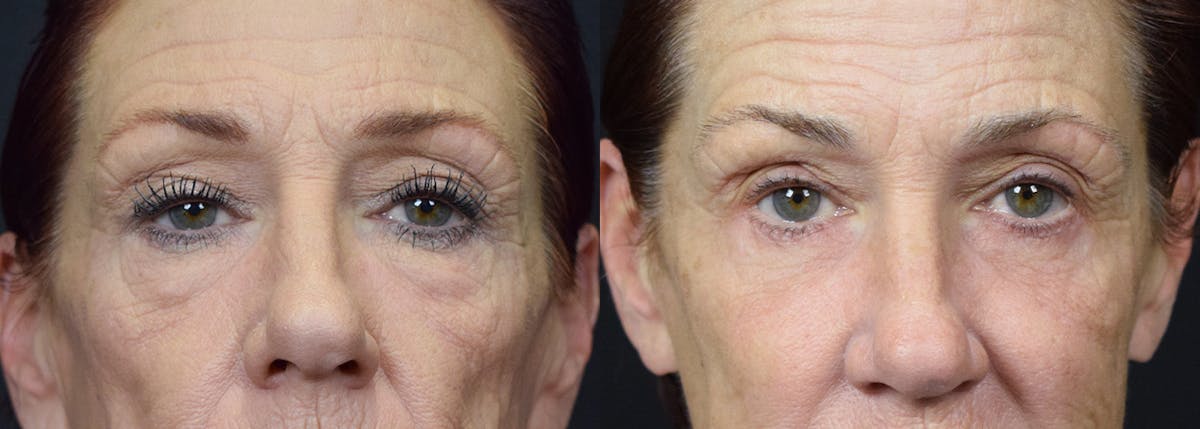 Blepharoplasty result at Stile Aesthetics