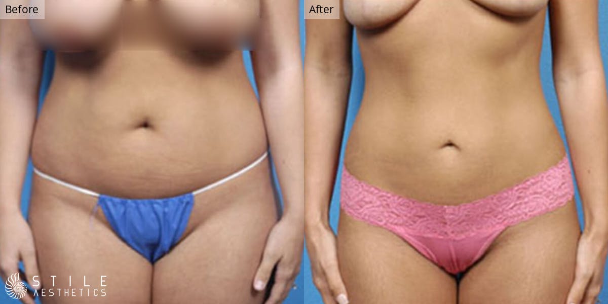 Tummy Tuck result at Stile Aesthetics