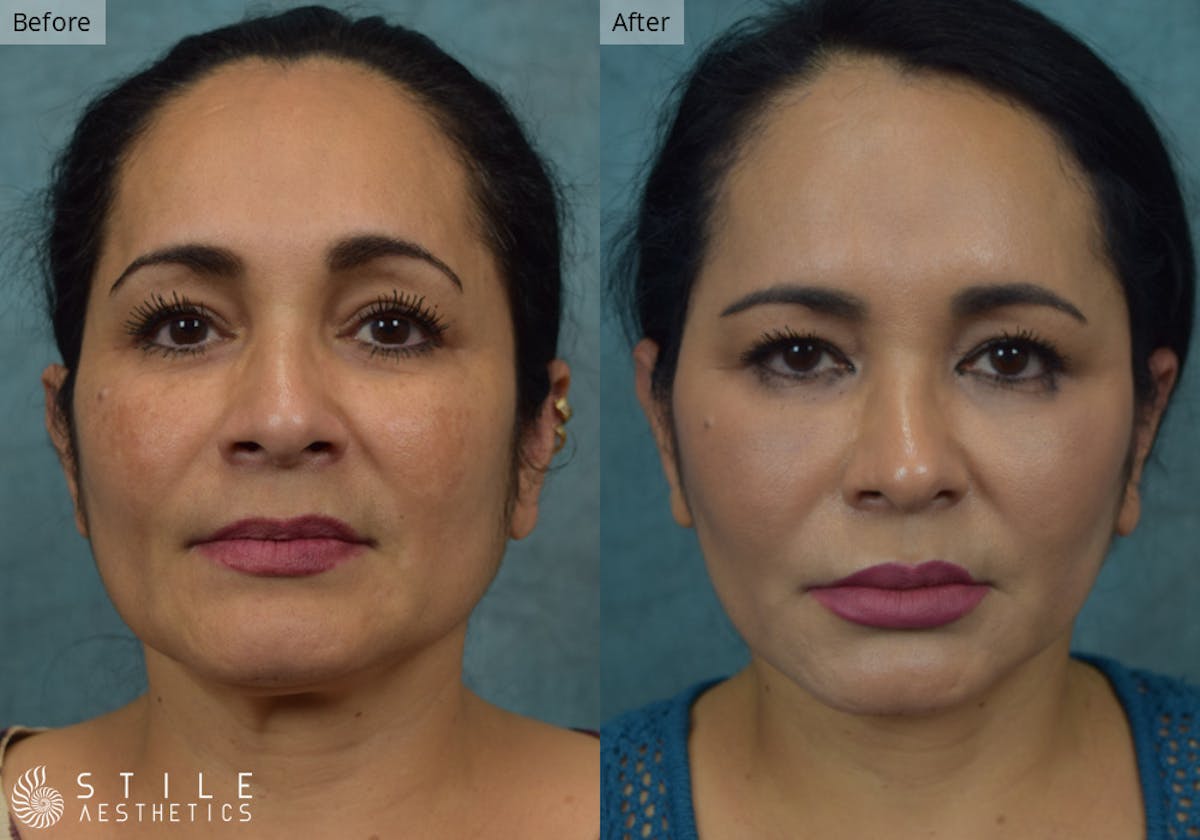 Facelift result at Stile Aesthetics