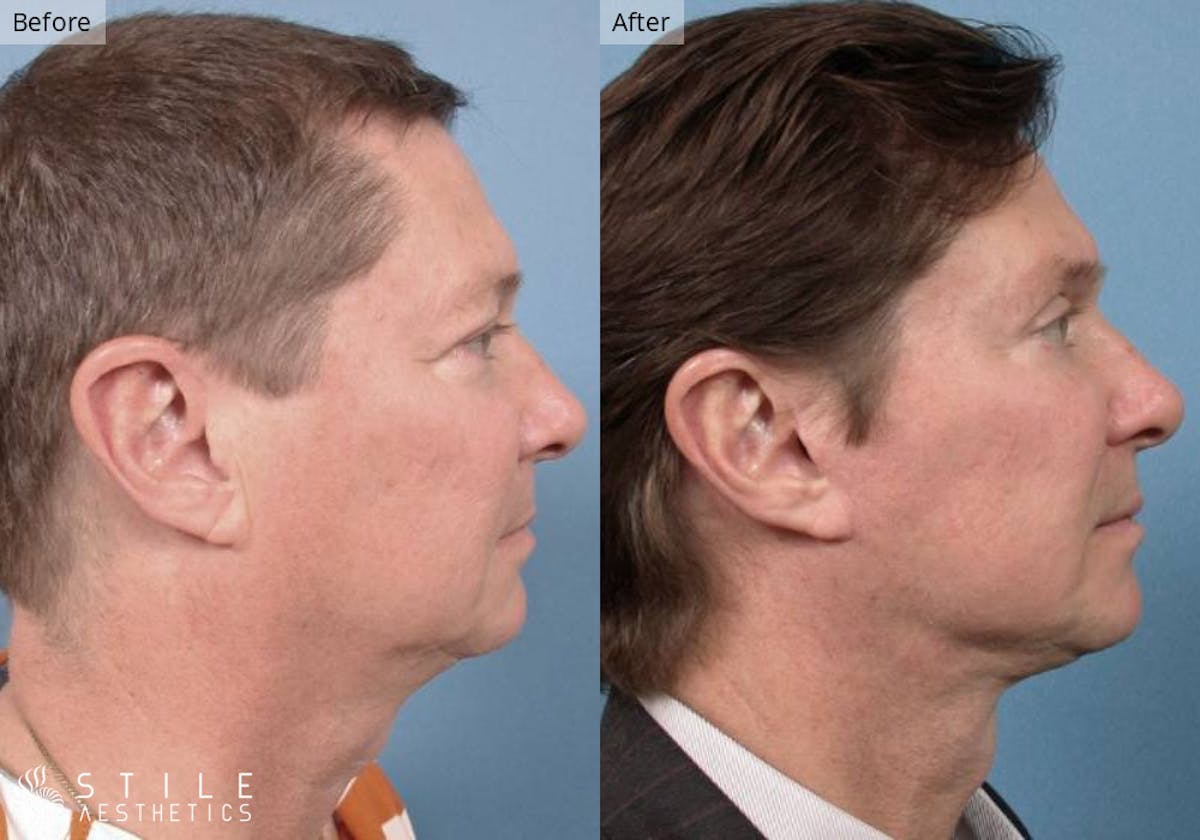 Neck Lift result at Stile Aesthetics
