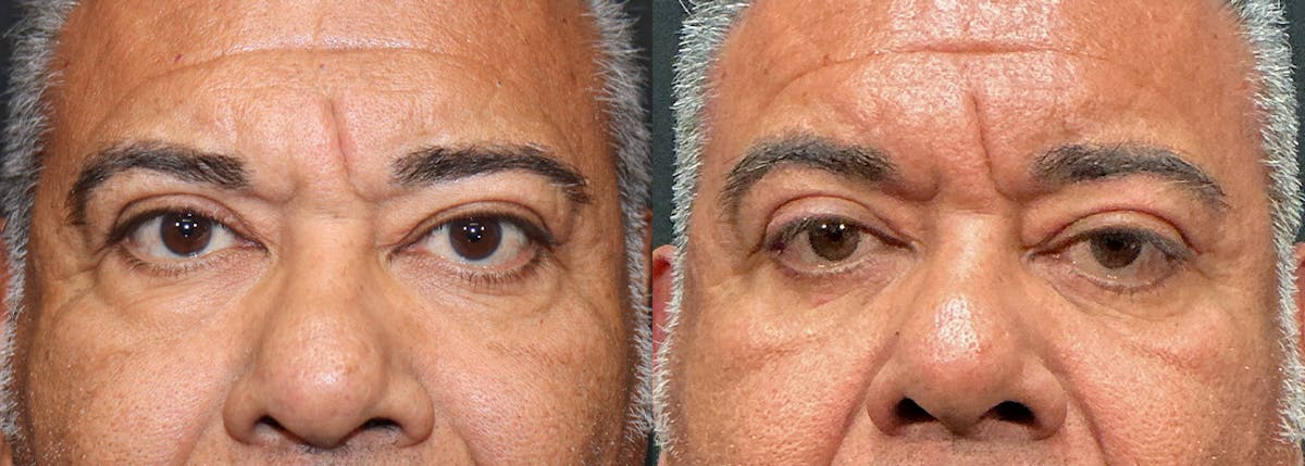Blepharoplasty result at Stile Aesthetics