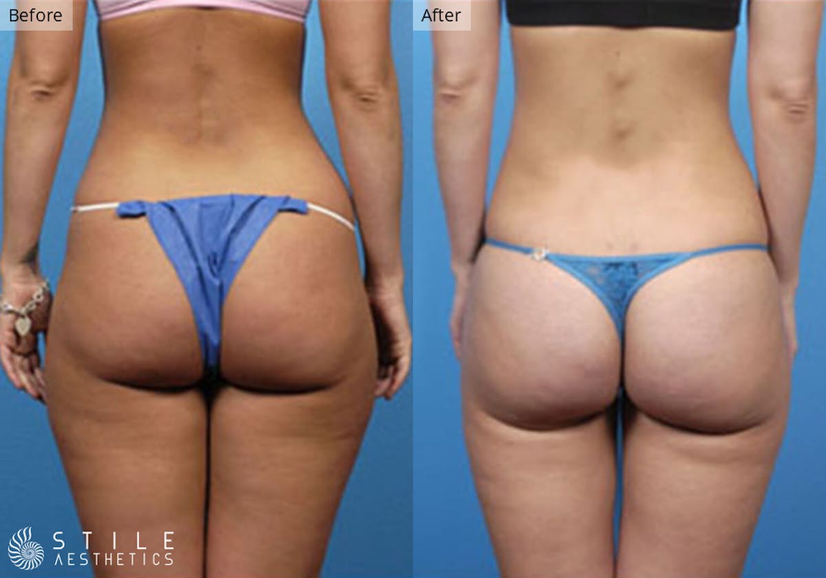 Liposuction result at Stile Aesthetics