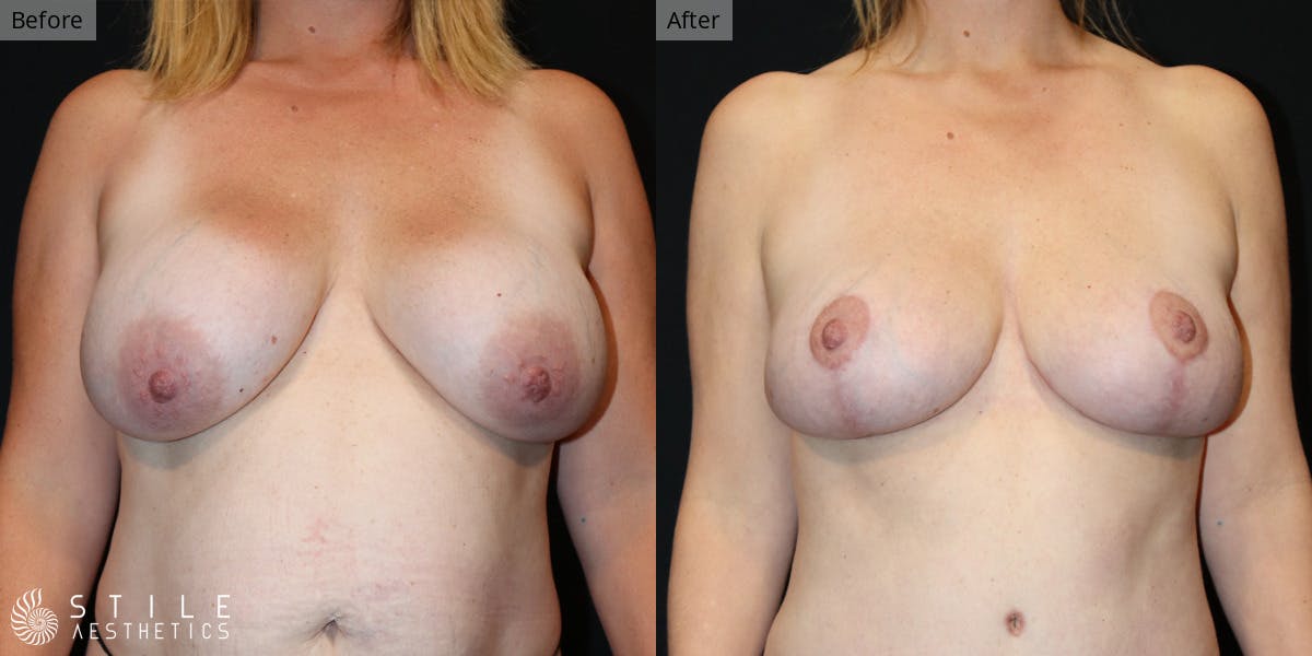 Breast Lift result at Stile Aesthetics