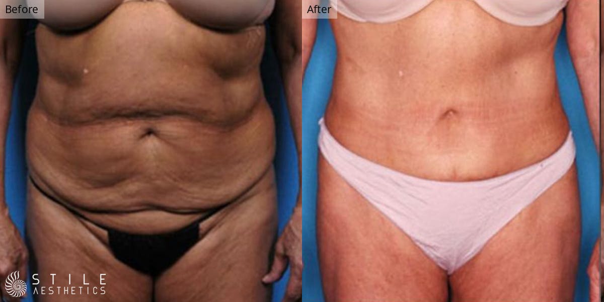 Tummy Tuck result at Stile Aesthetics