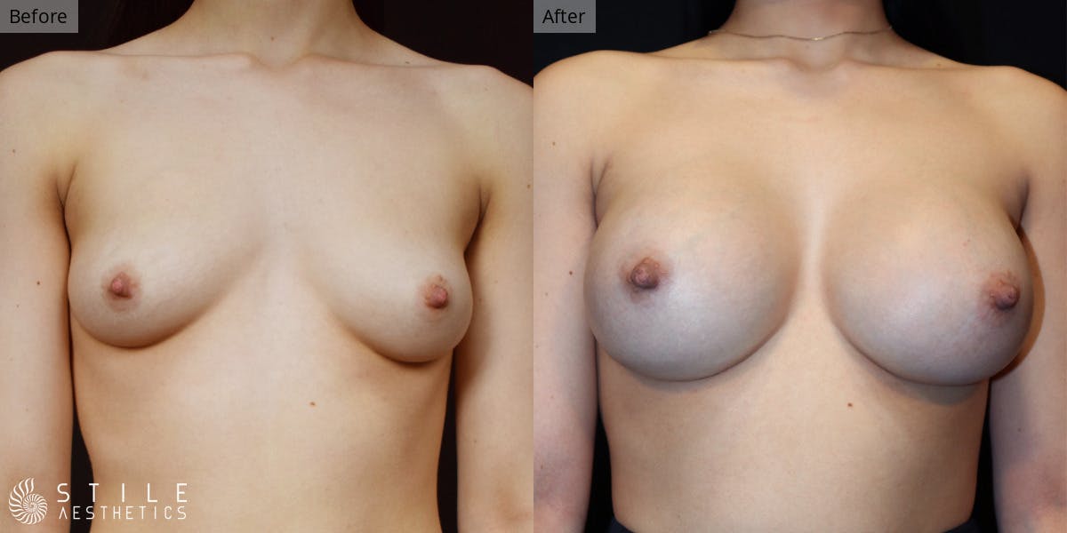 Breast Augmentation result at Stile Aesthetics