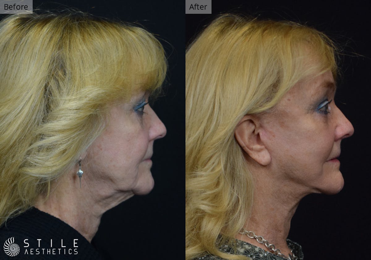 Neck Lift result at Stile Aesthetics