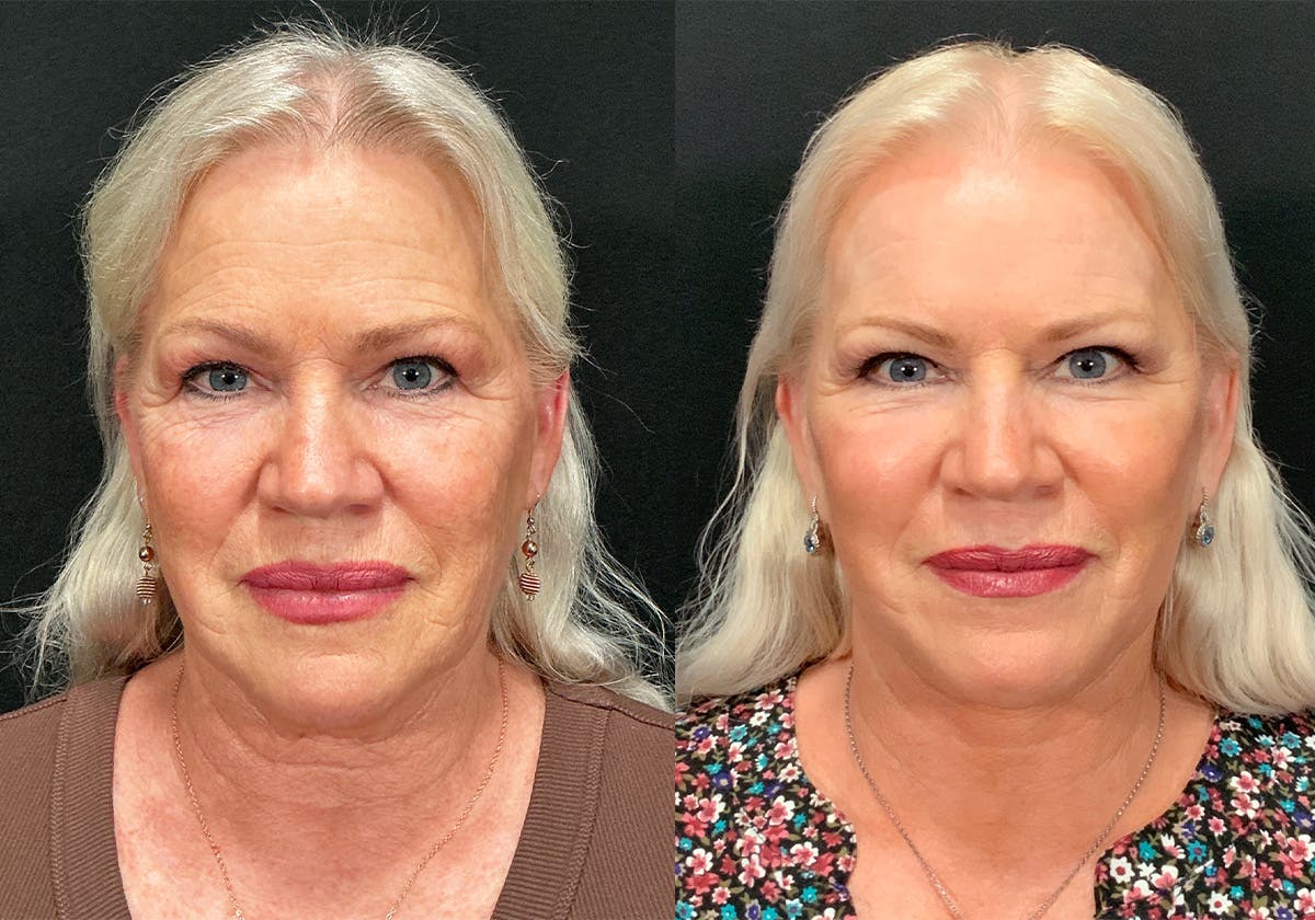 Facelift result at Stile Aesthetics