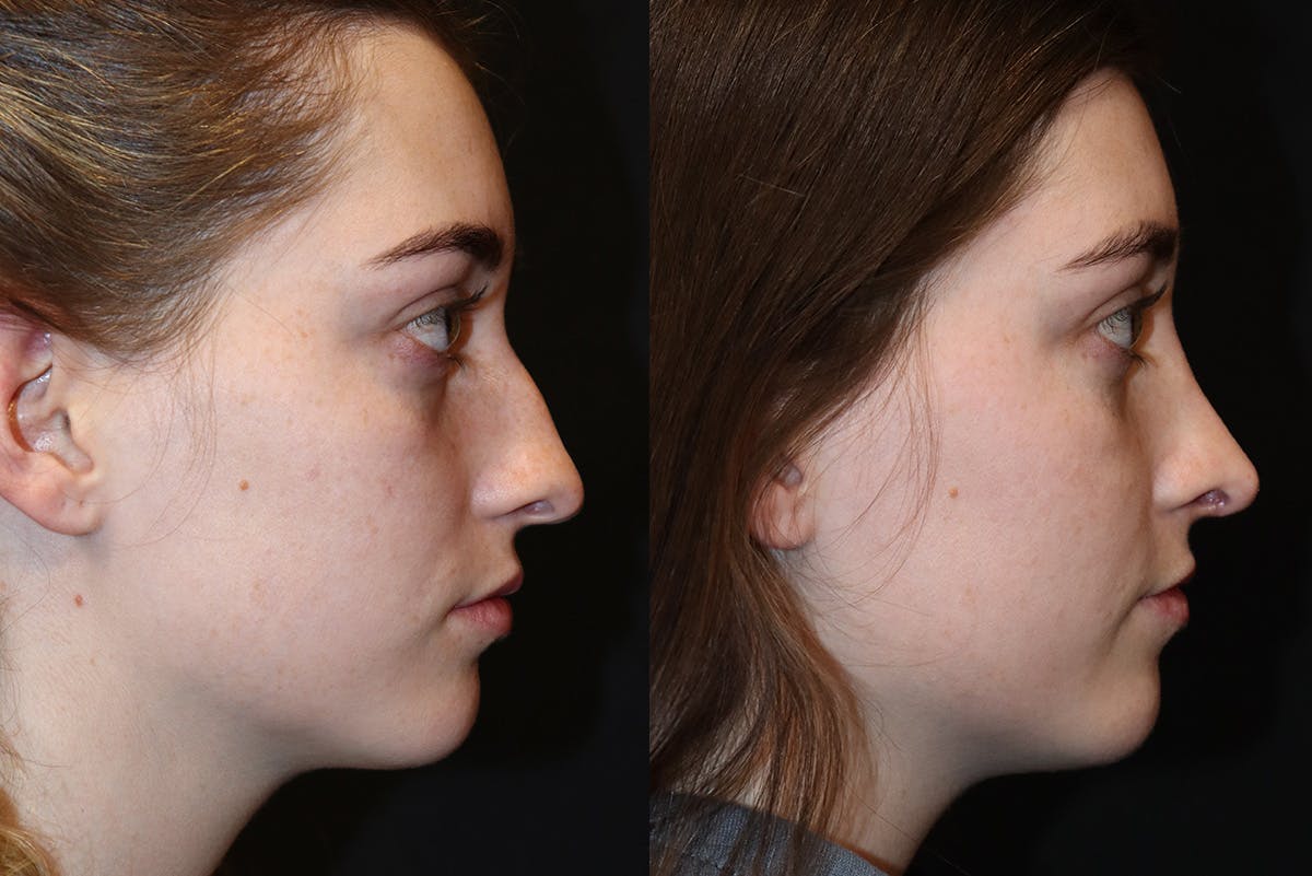 Rhinoplasty result at Stile Aesthetics