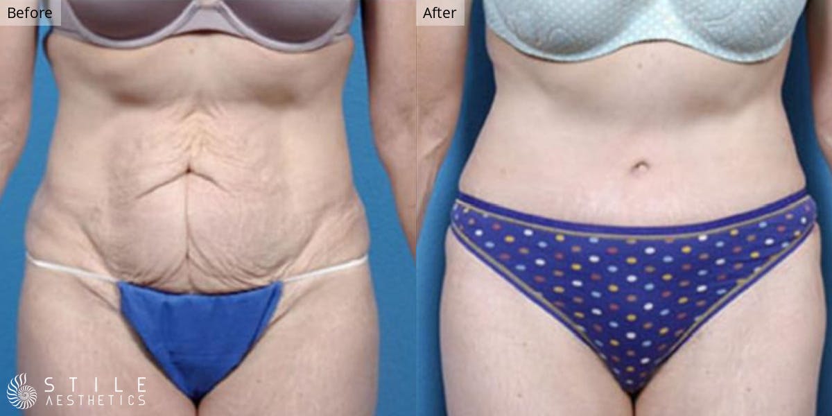 Tummy Tuck result at Stile Aesthetics