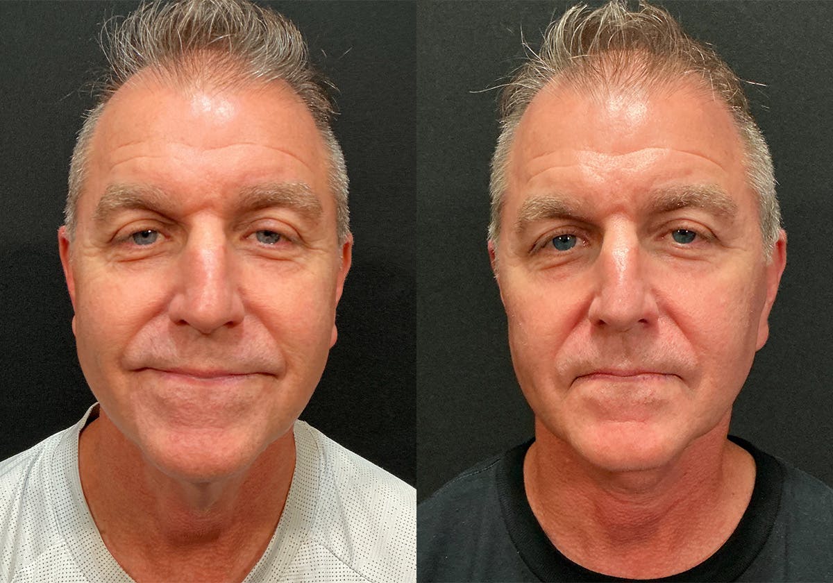 Facelift result at Stile Aesthetics