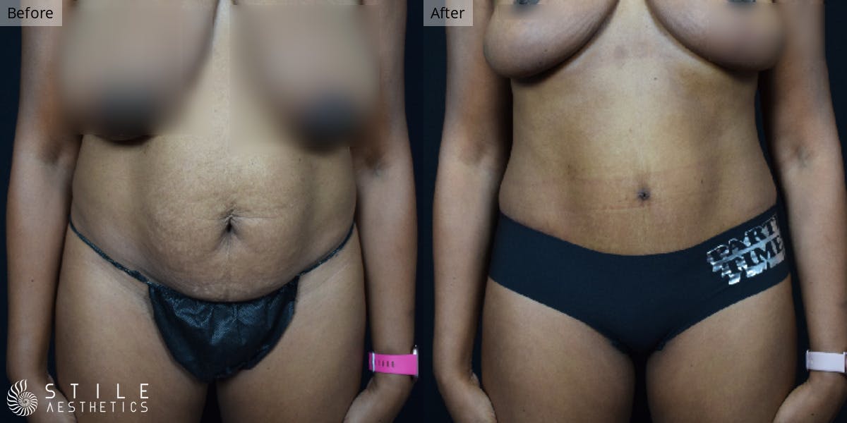 Tummy Tuck result at Stile Aesthetics