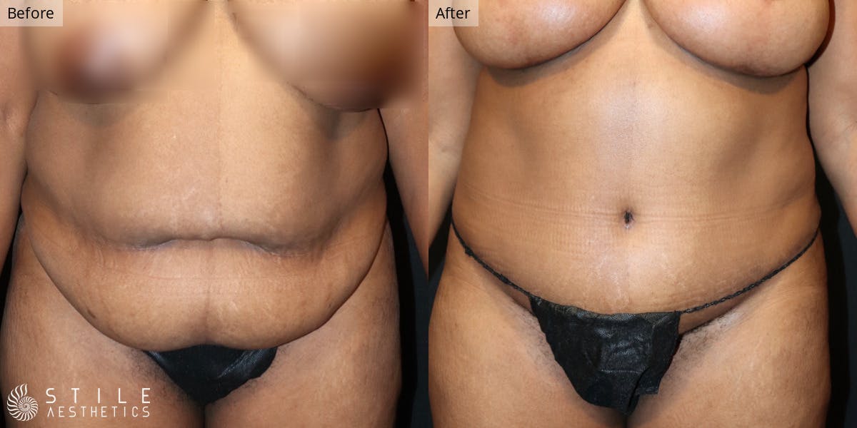 Tummy Tuck result at Stile Aesthetics