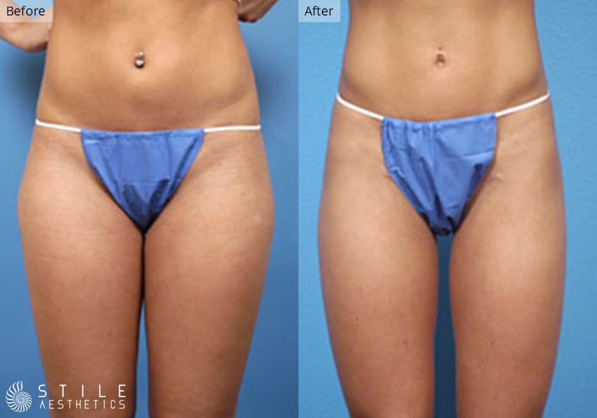 Liposuction result at Stile Aesthetics