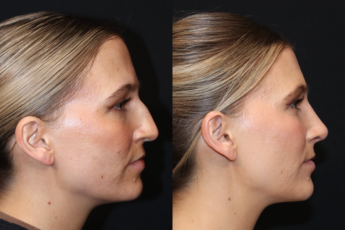 Rhinoplasty result at Stile Aesthetics