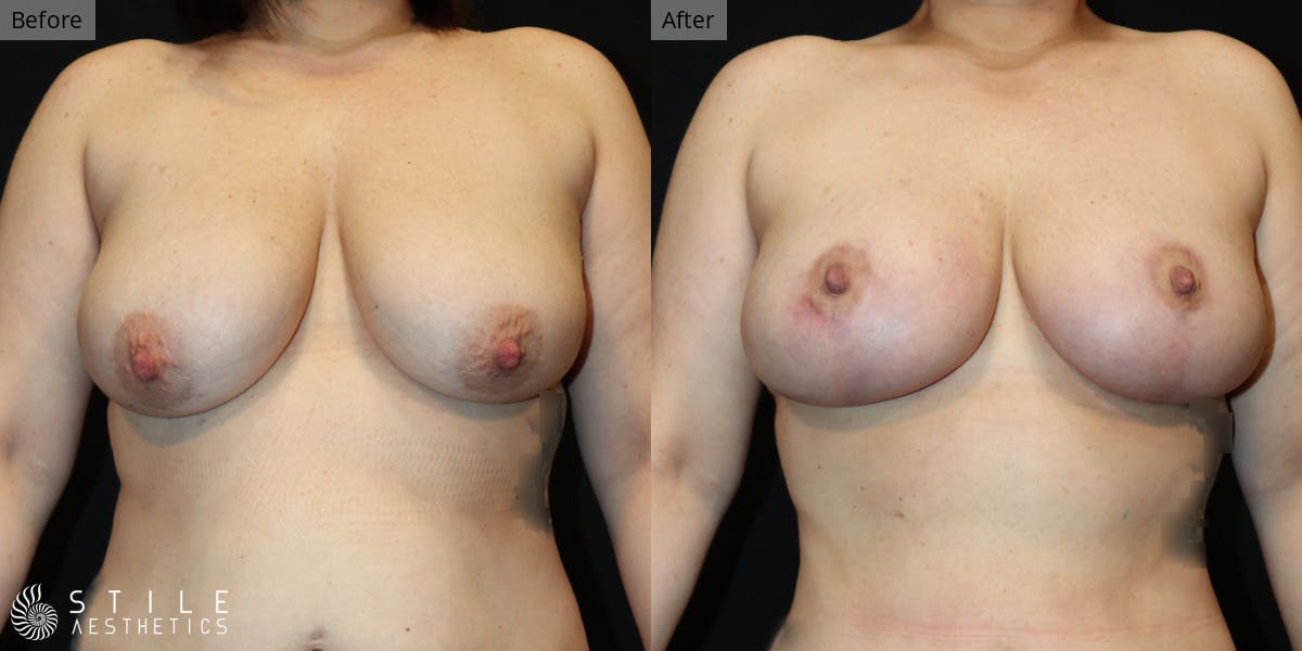 Breast Lift result at Stile Aesthetics