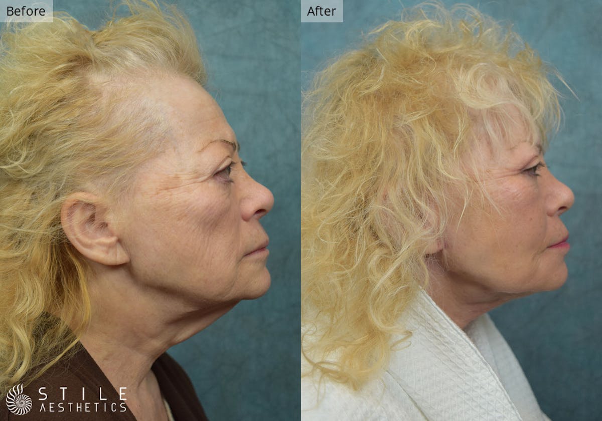Neck Lift result at Stile Aesthetics