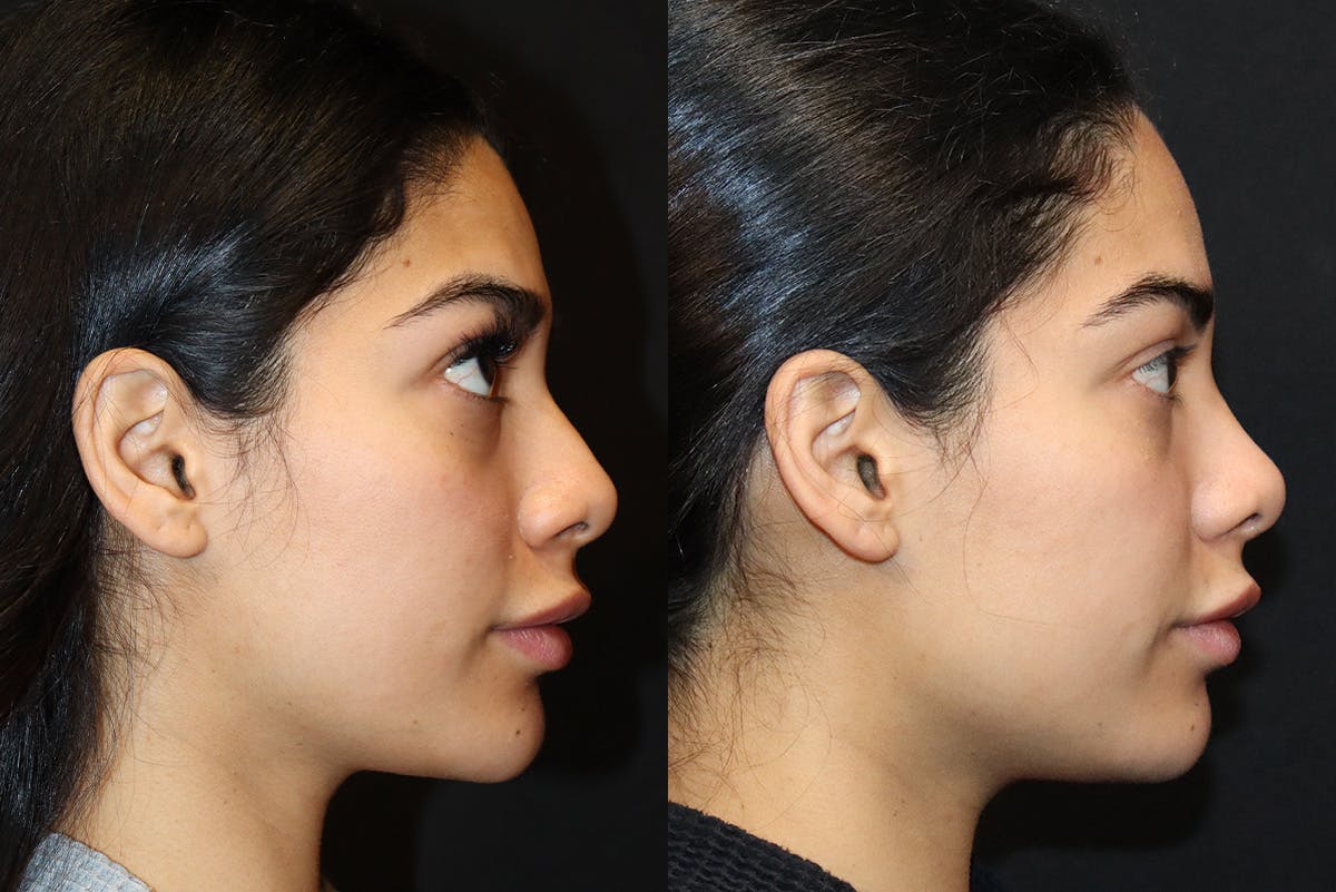 Rhinoplasty result at Stile Aesthetics