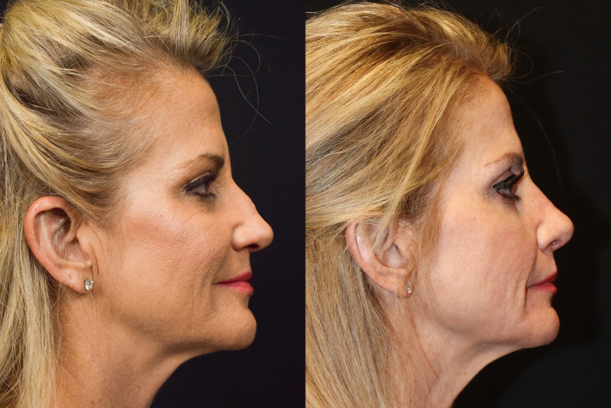 Rhinoplasty result at Stile Aesthetics