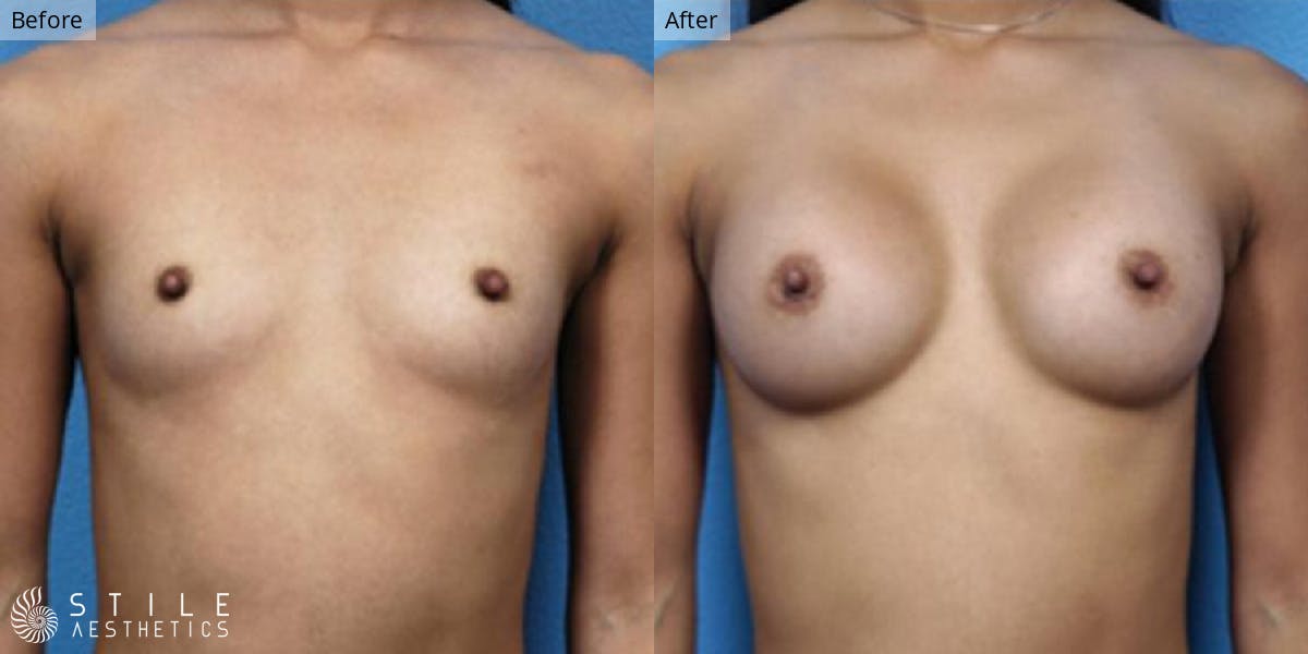 Breast Augmentation result at Stile Aesthetics