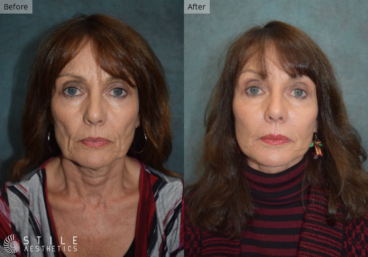 Facelift result at Stile Aesthetics