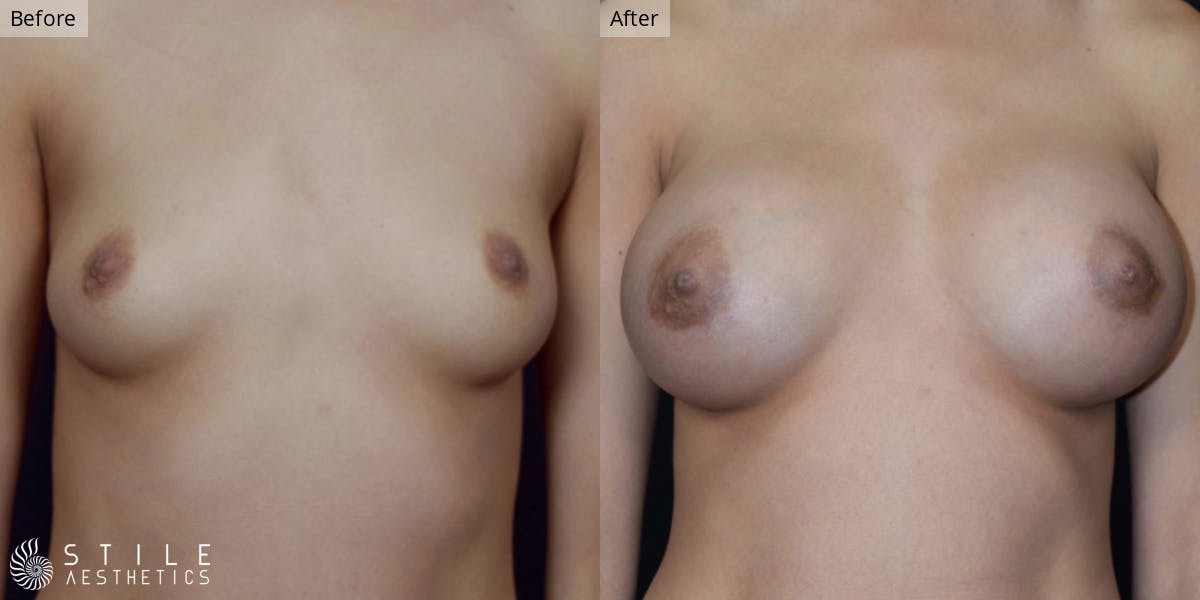Breast Augmentation result at Stile Aesthetics