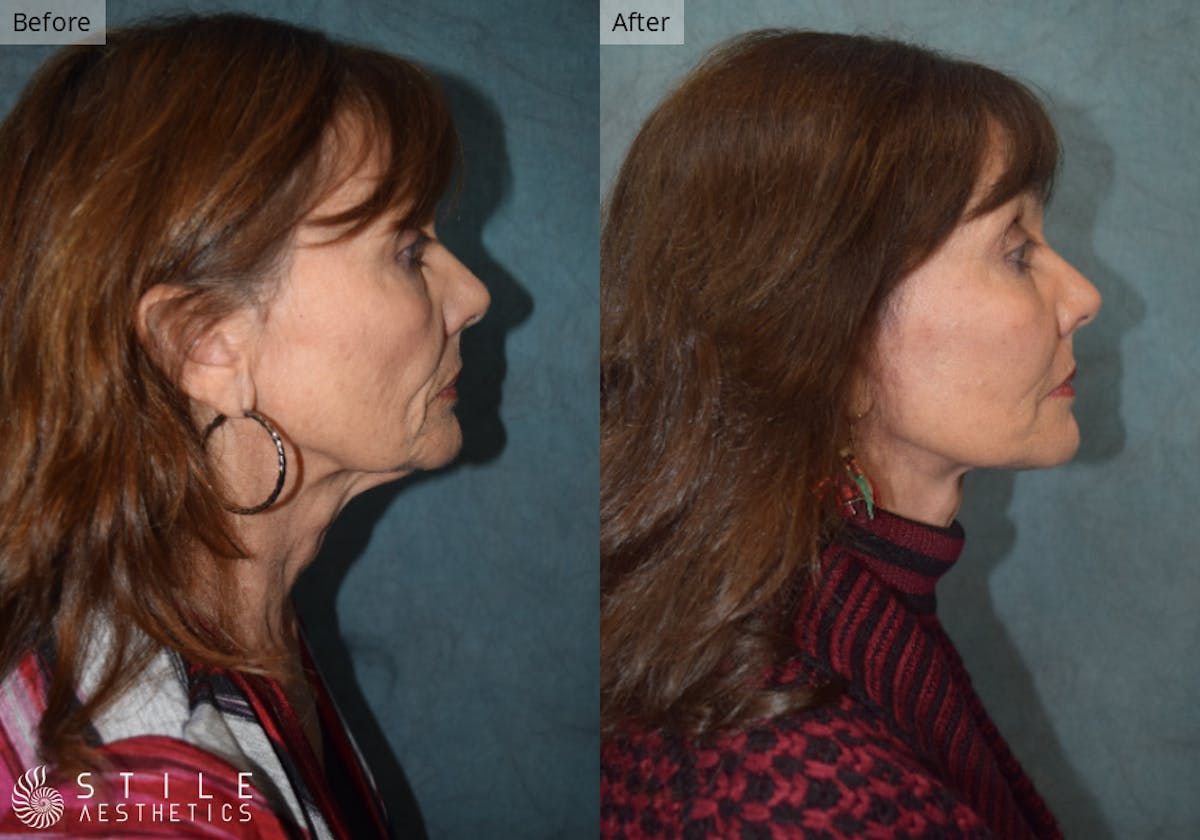 Neck Lift result at Stile Aesthetics