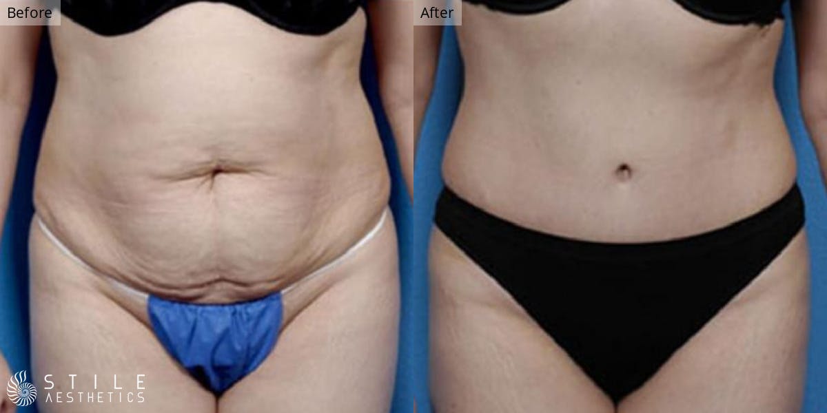 Tummy Tuck result at Stile Aesthetics