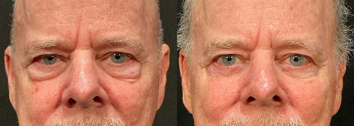 Blepharoplasty result at Stile Aesthetics