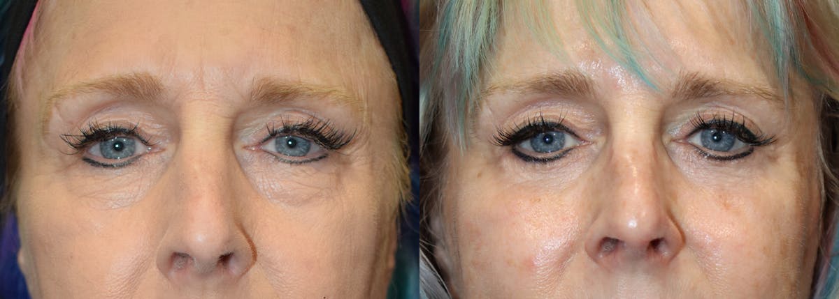 Blepharoplasty result at Stile Aesthetics