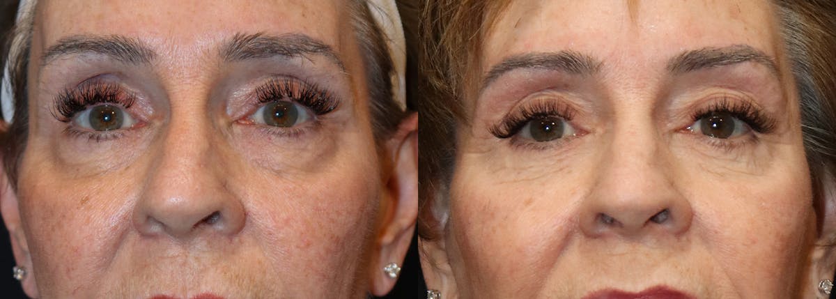 Blepharoplasty result at Stile Aesthetics