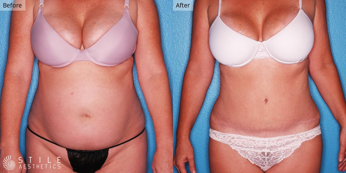 Tummy Tuck result at Stile Aesthetics